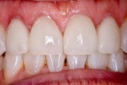 After photo showing the gap closed and teeth aligned for a straight, even appearance.