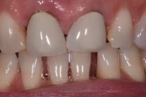 Before photo showing a smile with yellowed, discolored teeth and minor crowding.