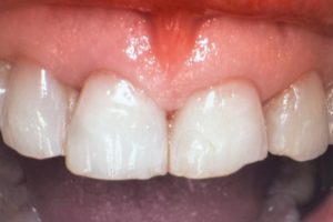 Before photo showing a front tooth that is discolored and damaged compared to the surrounding teeth.
