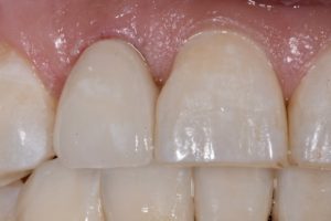 Before photo showing teeth with translucent edges and slight discoloration.