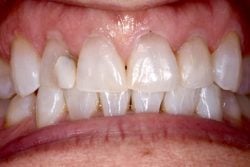 Before photo showing a smile with a gap between the front teeth and slight rotation.