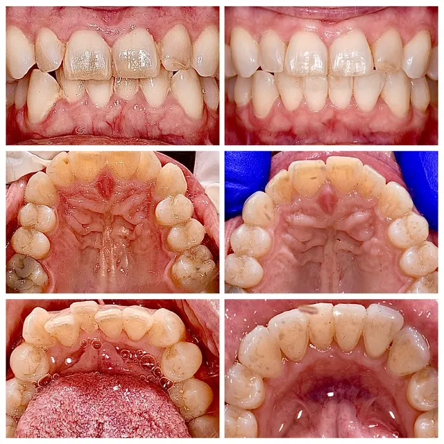 Before and after clear aligner treatment: front, upper arch, and lower arch views showing crowded teeth before and straightened teeth after