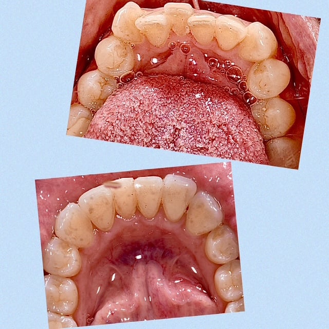 Lower arch close-up: crowded lower front teeth before clear aligner treatment (top) and straightened teeth after (bottom)